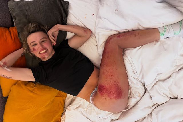 Katarzyna Niewiadoma exibiu corpo massacrado pela queda (Foto: @thomas_maheux - Instagram/Katarzyna Niewiadoma)