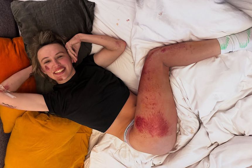 Katarzyna Niewiadoma exibiu corpo massacrado pela queda (Foto: @thomas_maheux - Instagram/Katarzyna Niewiadoma)