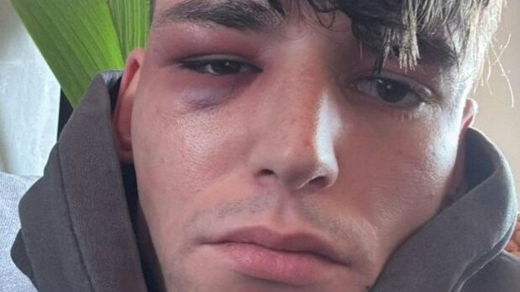 Pascal Kaiser mostra como ficou após novo ataque - Foto: Pascal Kaiser