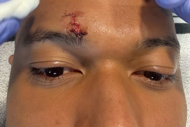 Mbappé mostra ferida/Instagram