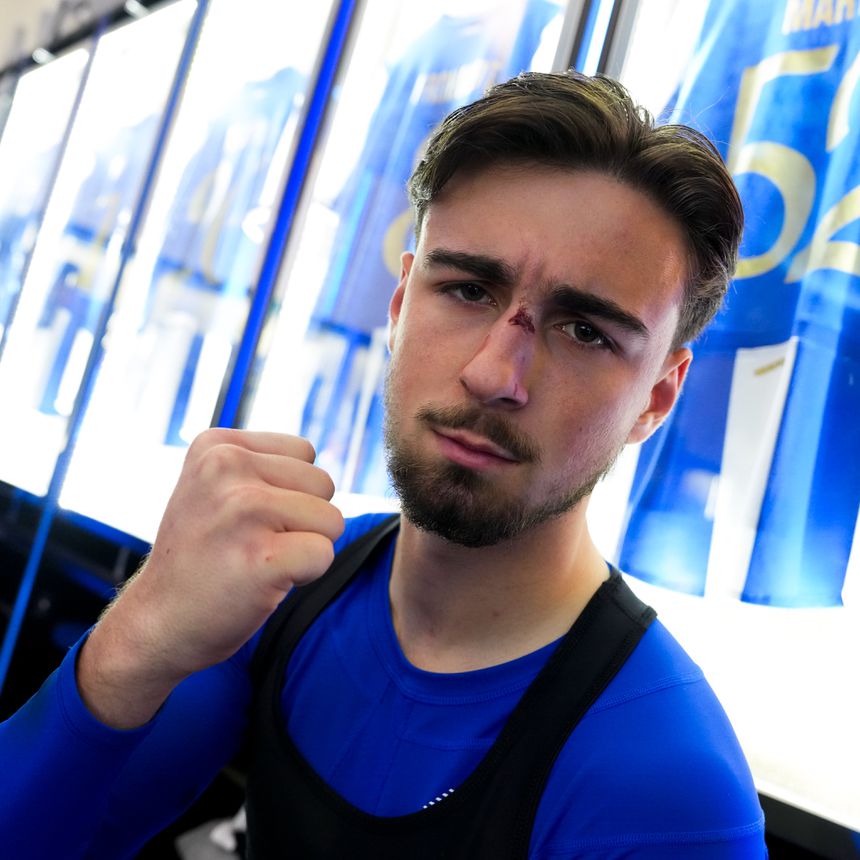 Martim Fernandes com o nariz partido (Foto: FC Porto/X)
