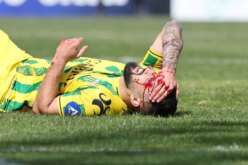 João Costinha ficou com a cabeça em sangue após choque com Diogo Spencer (Foto: Tondela/Instagram)