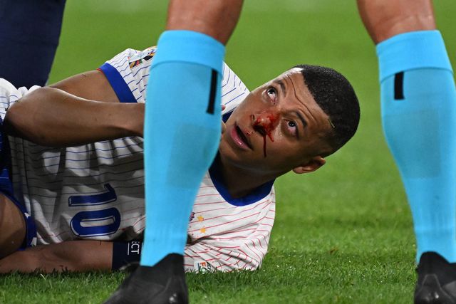 Veja bem como ficou o nariz de Kylian Mbappé