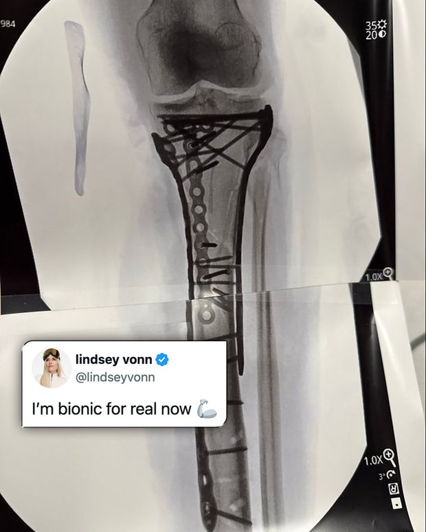 Lindsay Vonn partilha imagens após quinta cirurgia