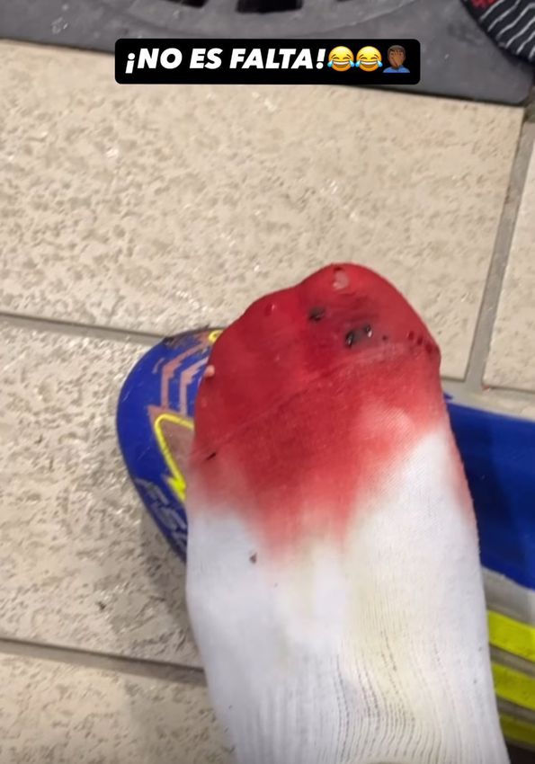 Meia branca do pé esquerdo de Yamal ficou vermelha devido ao sangue do avançado.