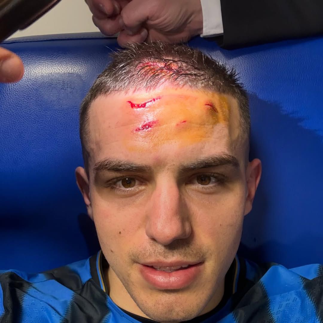 Nikola Krstovic ficou em mau estado depois de atingido por chuteira na testa no Atalanta-Dortmund - Instagram