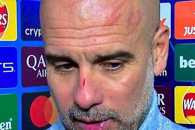 Agora a sério: Guardiola aborda arranhões na cara e deixa alerta