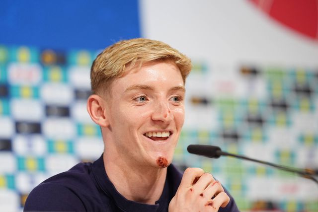 Internacional inglês explica acidente caricato de bicicleta: «Saí disparado…»