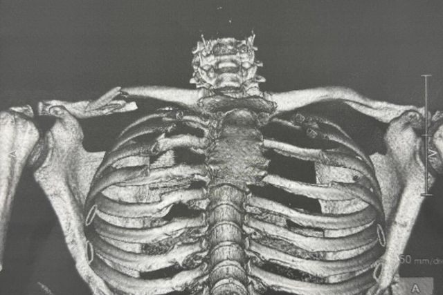 MotoGP: clavícula desfeita e regresso de Jorge Martín apontado para Portugal