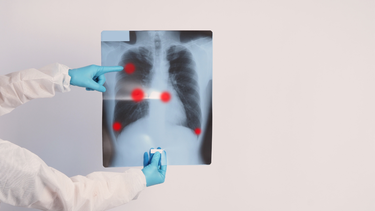 Таушанов от Надзорния съвет на НЗОК: Бум на рак на белия дроб в IV стадий след Ковид