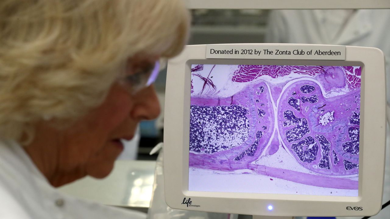 Скринингова кампания за остеопороза обяви РЗИ - Кърджали