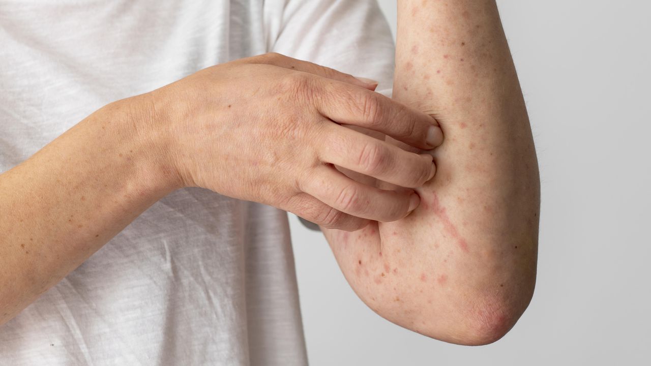 Ваксината срещу варицела, която в момента е препоръчителна, ще стане