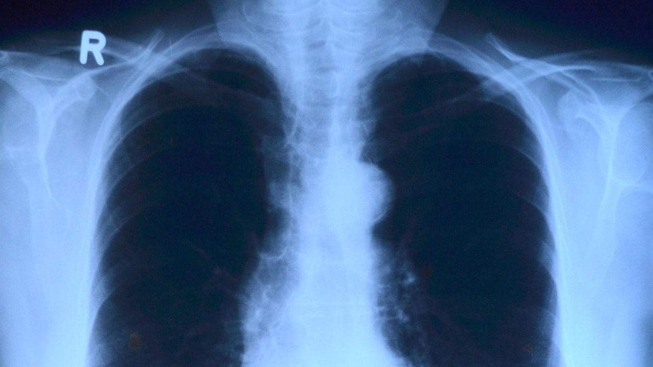 Хроничната обструктивна белодробна болест - причини, превенция и лечение