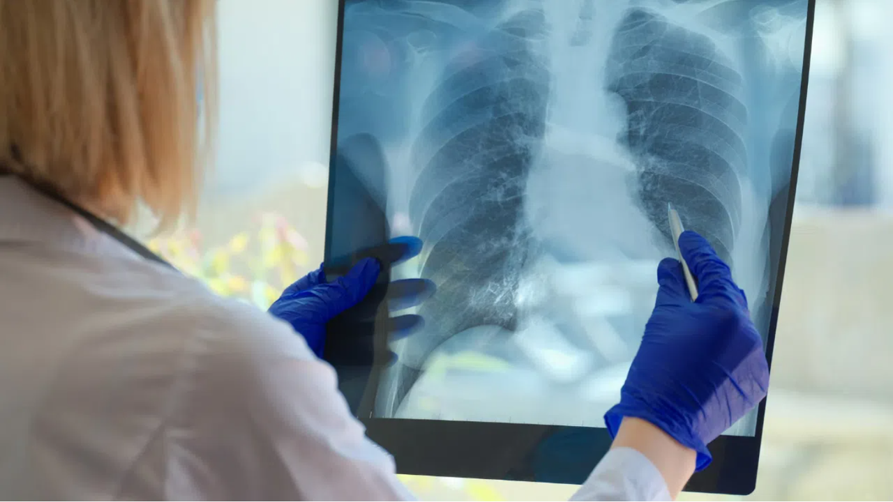 В ход са безплатните консултации за туберкулоза в страната. От