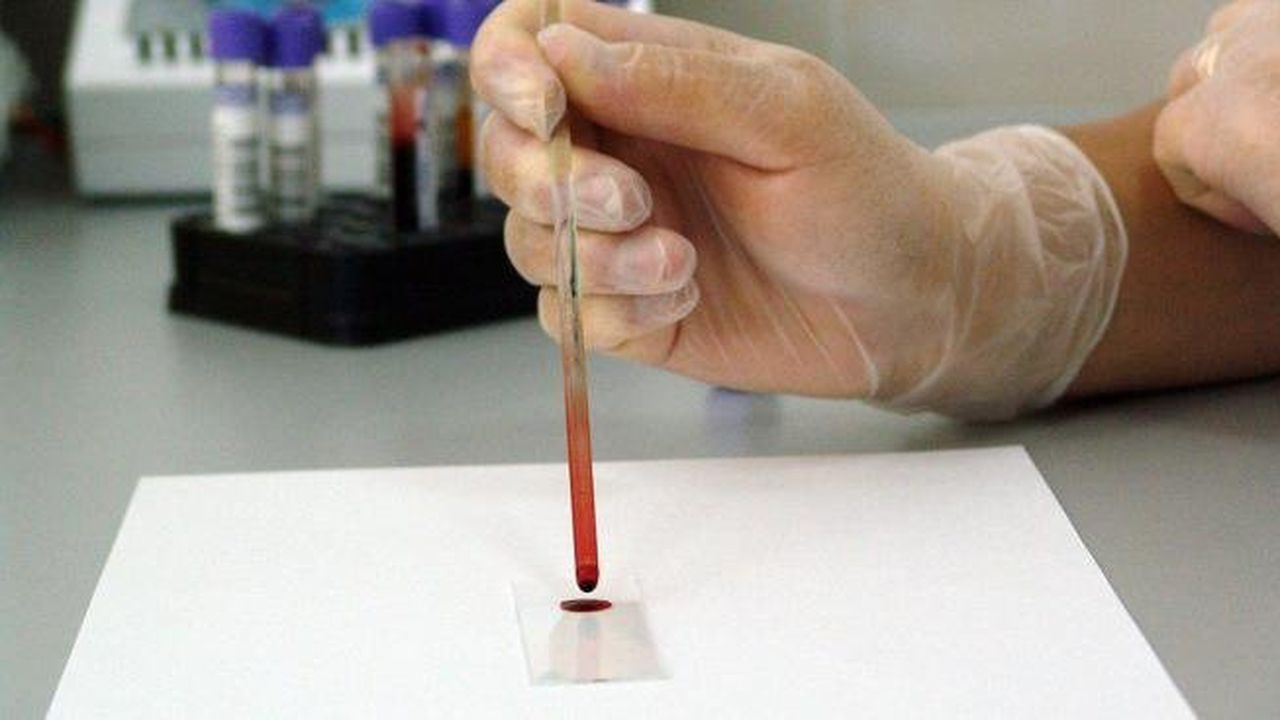 Нови 11 случаи на хепатит А са регистрирани в Ловешка област