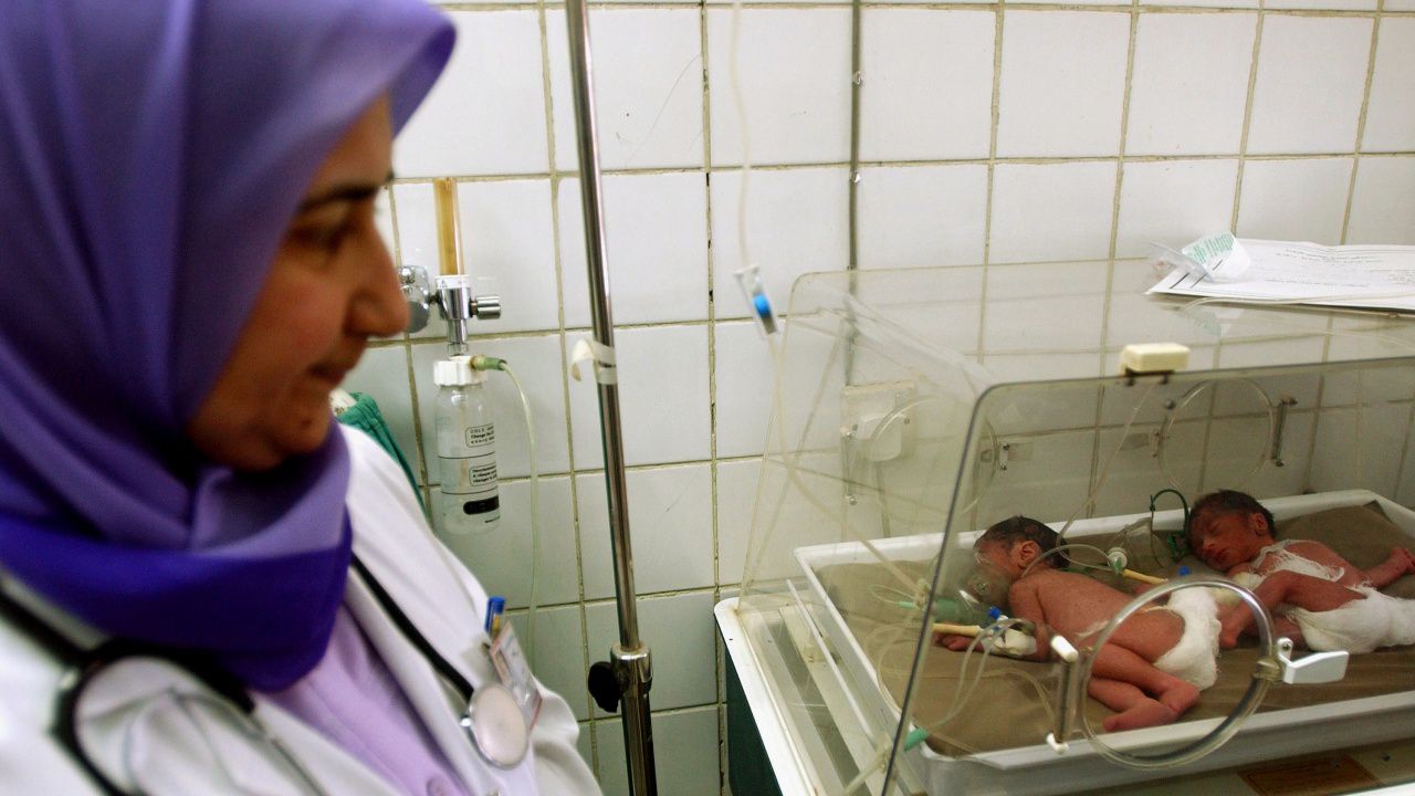 Разделиха с операция сиамски близнаци в Йордания