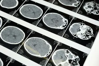 Мозъчен имплант срещу рак привлече инвестиции от OpenAI и Питър Тийл
