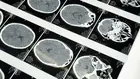 Мозъчен имплант срещу рак привлече инвестиции от OpenAI и Питър Тийл