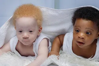 Близнаците Даниел и Дейвид, които имат различен цвят на кожата