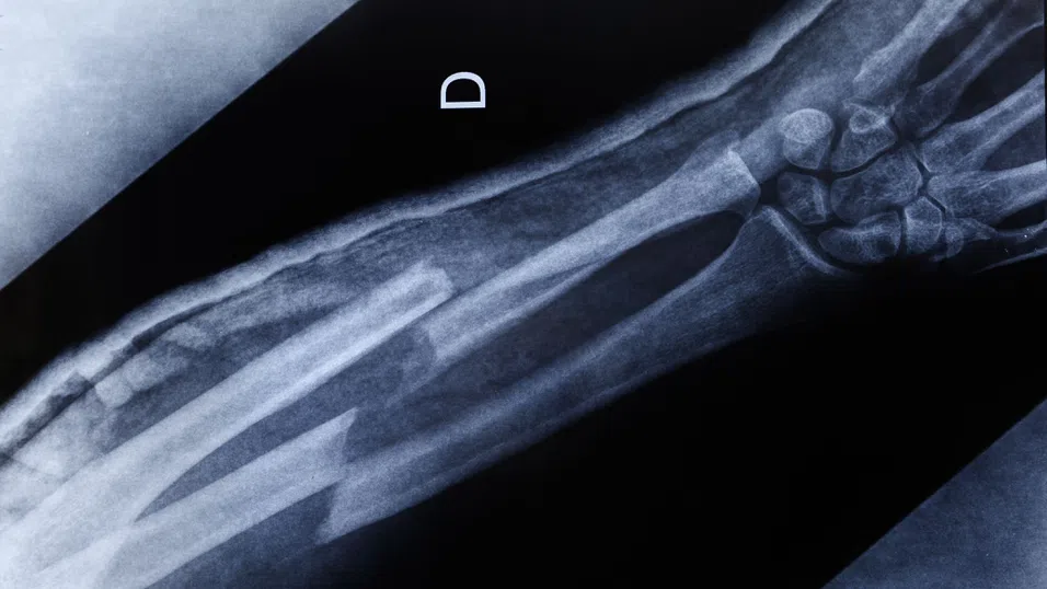 Микропластмасите са невидим риск за костите ни, показва ново изследване