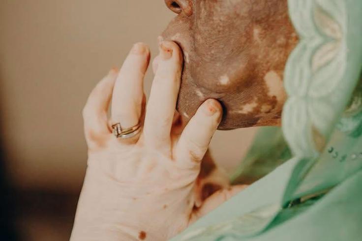VITILIGO : TOUT CE QU'IL FAUT SAVOIR SUR CETTE MALADIE QUI FAIT ENCORE TROP PARLER LES REGARDS