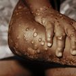 Ghana's Mpox cases soar to 302 as GHS confirms 20 new infections