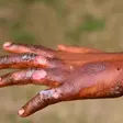 How to treat burns: A step-by-step first aid guide