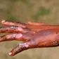 How to treat burns: A step-by-step first aid guide