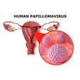 Genital warts: 7 things women should know about HPV