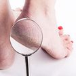 Tired of your cracked heels? Here are 5 effective home remedies to help you get rid of it