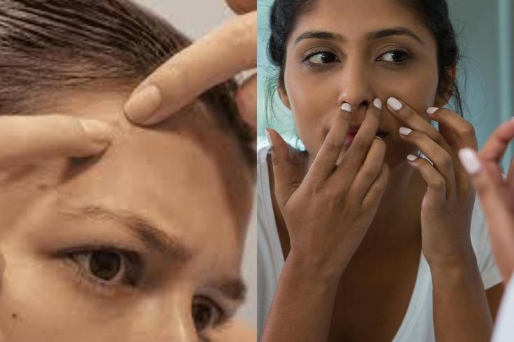 How Popping Facial Pimples Can Lead to Blindness — What You Need to Know
