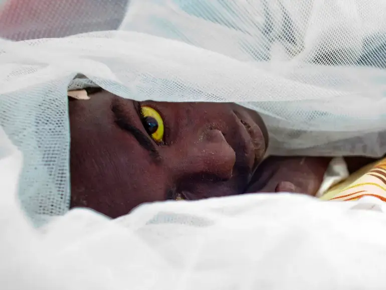Yellowing of the eyes or skin
