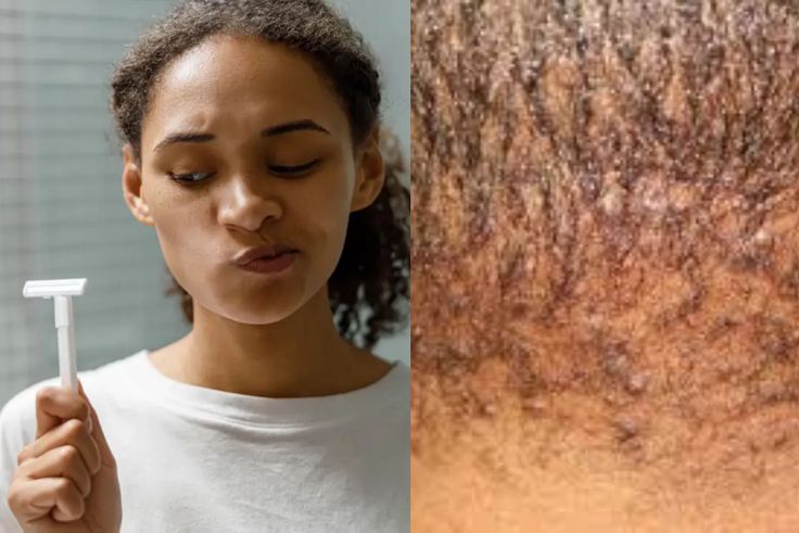 Ghanaian dermatologist warns against shaving too close to the skin- Here's why