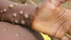 Mpox cases in Ghana rise to 4 as Accra, Western Region report infections