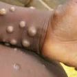 Mpox cases in Ghana rise to 4 as Accra, Western Region report infections