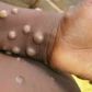 Mpox cases in Ghana rise to 4 as Accra, Western Region report infections