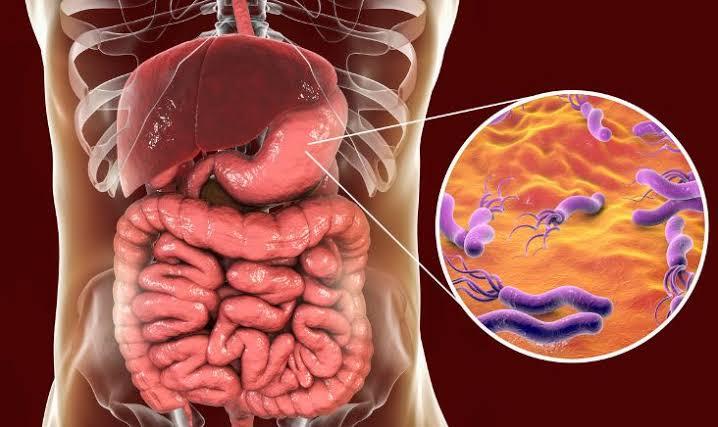 Helicobacter pylori infection
