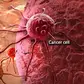 5 deadliest types of cancer worldwide
