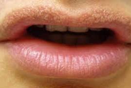 Noticed White Bumps on Your Lips? Here’s What Your Body Might Be Telling You