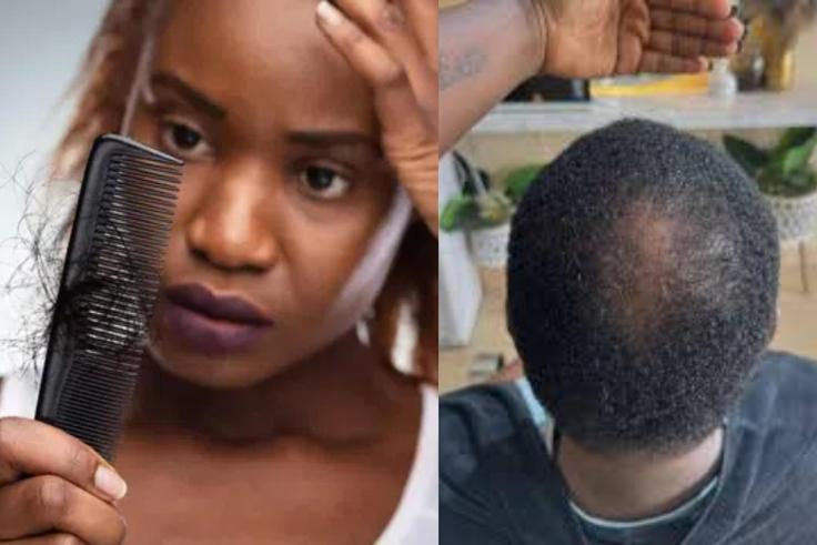 Are you noticing more hair on your pillow? 10 early signs you may be going bald