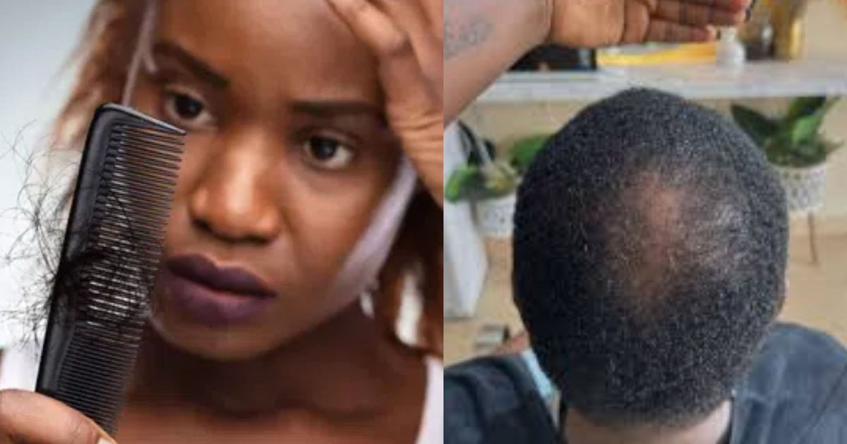 Are you noticing more hair on your pillow? 10 early signs you may be going bald