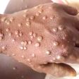 Mpox in Ghana: What you need to know about the re-emerging disease