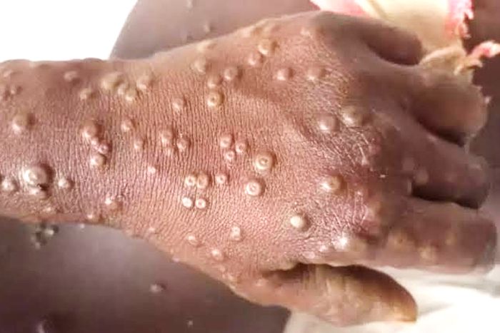 Mpox in Ghana: What you need to know about the re-emerging disease