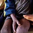 Ghana records its first monkey pox death, 23 confirmed active cases