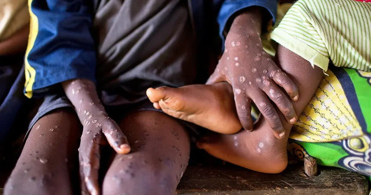 Ghana records its first monkey pox death, 23 confirmed active cases ...