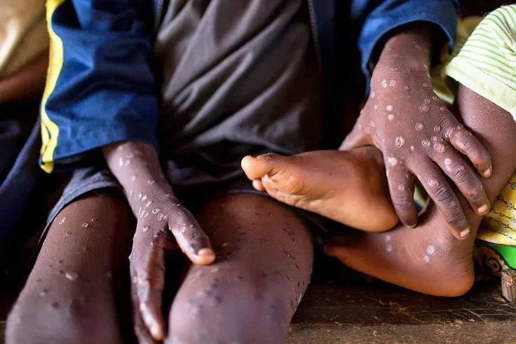 Ghana records its first monkey pox death, 23 confirmed active cases