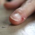 Skin peeling around the nail