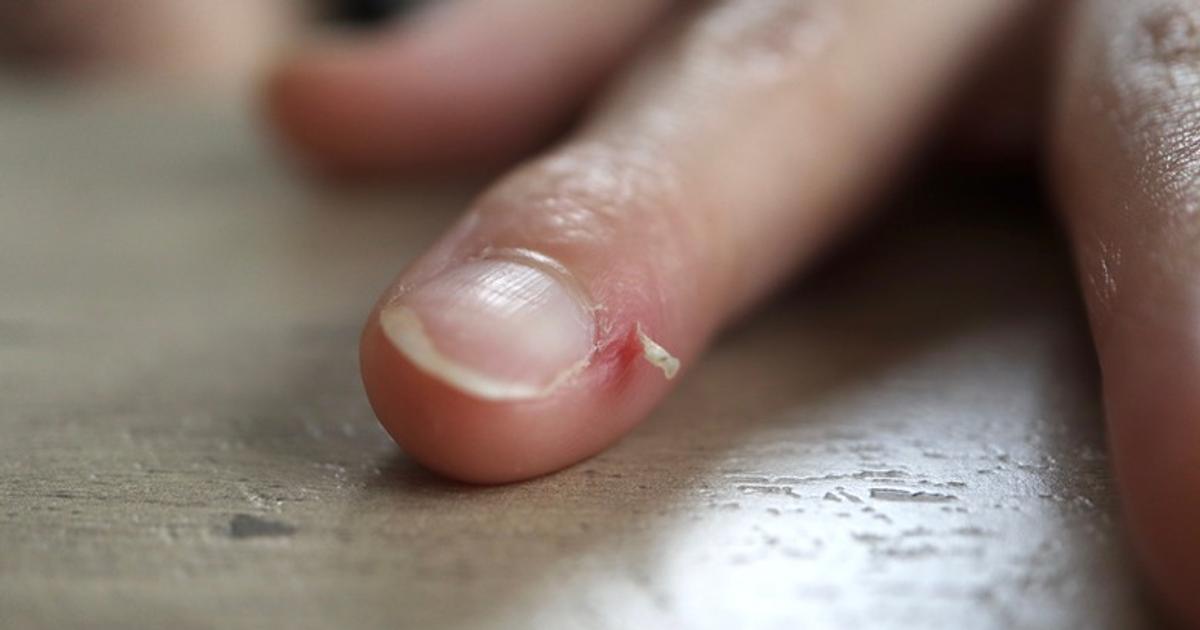 Why your skin keeps peeling or cracking - common causes and simple remedies