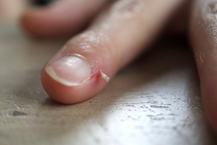 Skin peeling around the nail