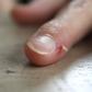 Skin peeling around the nail
